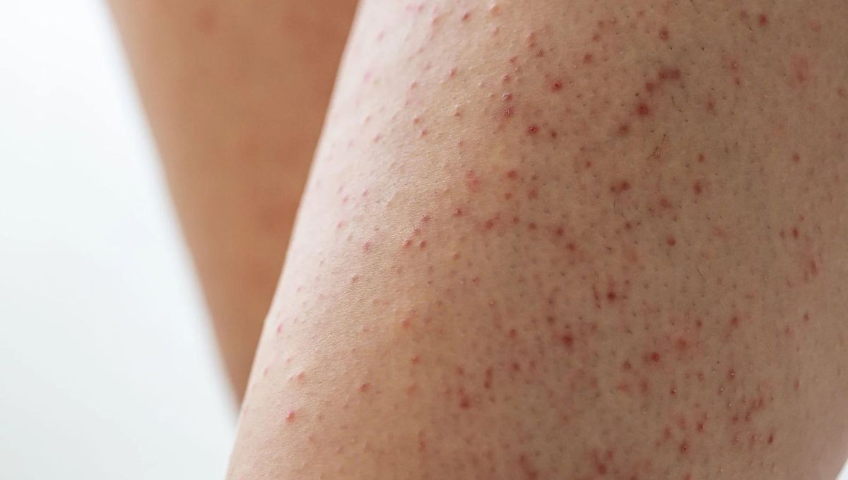 Queratosis pilares, una afección cutánea. Queratosis pilares, una afección cutánea. 