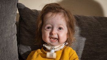 Isla, el único caso en el mundo de una niña con la enfermedad de Benjamin Button