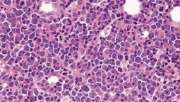 Linfoma de células del manto: alertan sobre un cáncer hematológico poco frecuente