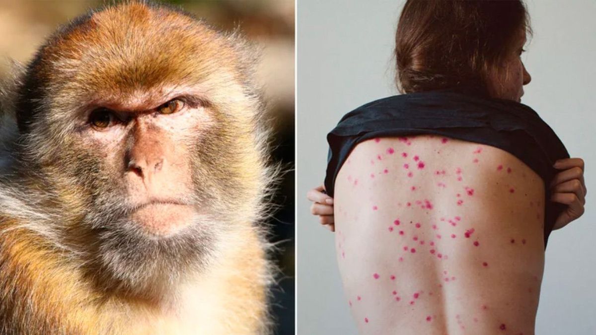 La llamada Viruela del mono ha despertado las alarmas sanitarias en varios pa&iacute;ses&nbsp;