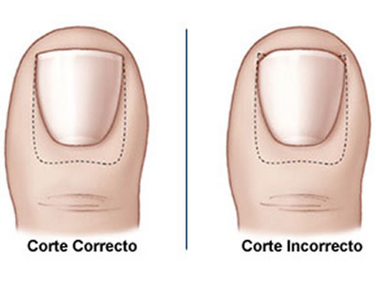 Un corte de uñas adecuado, puede prevenir numerosos problemas podológicos y mantener la salud de nuestros pies a largo plazo. Un corte de uñas adecuado, puede prevenir numerosos problemas podológicos y mantener la salud de nuestros pies a largo plazo.