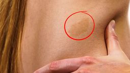 Qué significa tener una mancha de nacimiento en el cuerpo Qué significa tener una mancha de nacimiento en el cuerpo