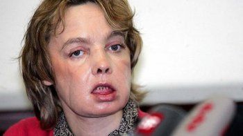 Falleció la primera paciente con el rostro trasplantado en el mundo