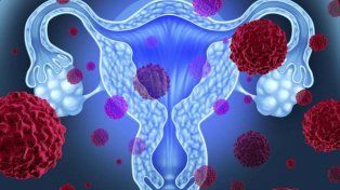 Una menstruación irregular aumenta el riesgo de cáncer de ovario