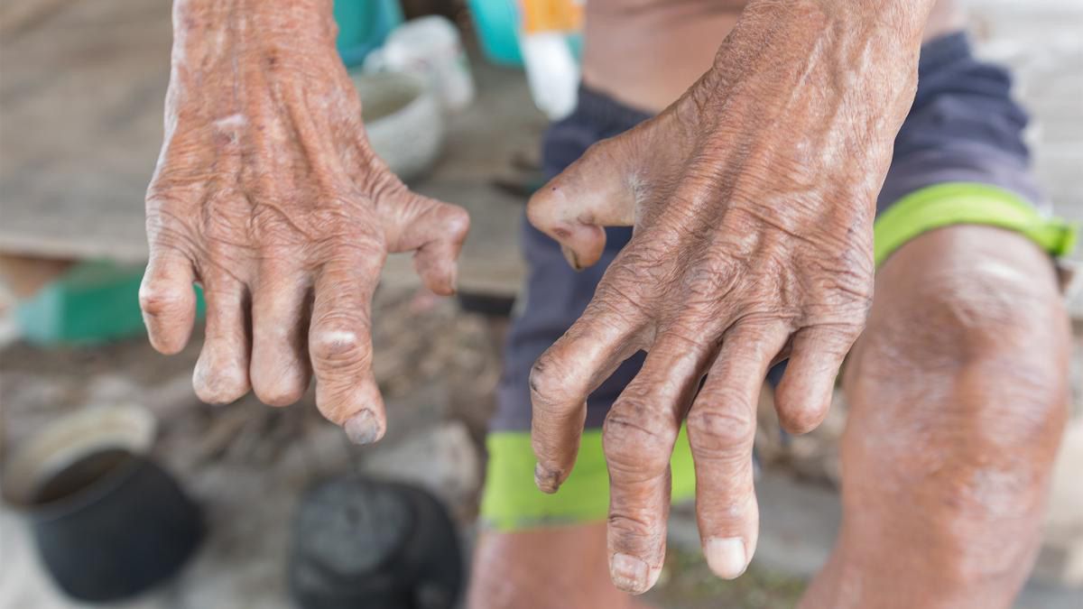 Lepra en Argentina: alta carga de la enfermedad con cerca de 150 casos por año