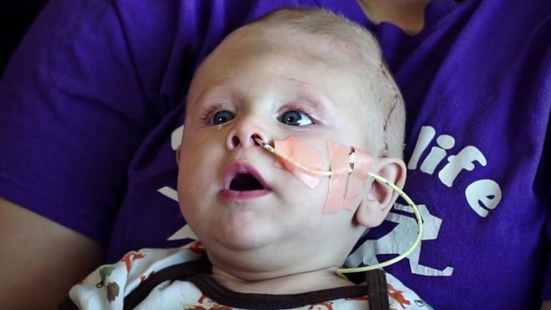 El Bebé Que Nació Con El Cerebro Fuera De La Cabeza Y Tuvo Una Operación Exitosa 6002