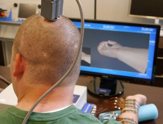 Logró mover su mano con la ayuda de un chip implantado en su cerebro
