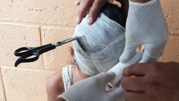 Una niña llegó al hospital con una tijera en la cabeza