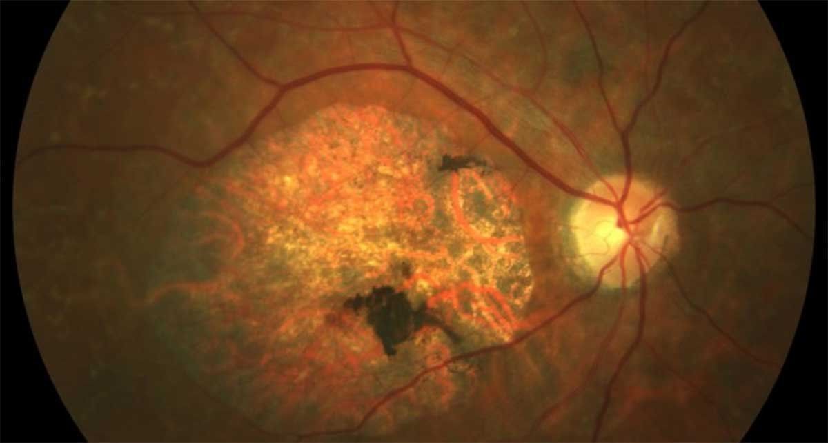 Científicos argentinos del Conicet y del Garrahan identificaron mutaciones de la retinopatía de Stargardt, enfermedad que causa una severa discapacidad visual.