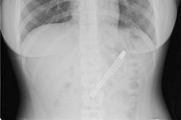 Insólito diagnóstico: le dijeron que estaba deprimida porque no comía, pero tenía una lapicera en el estómago