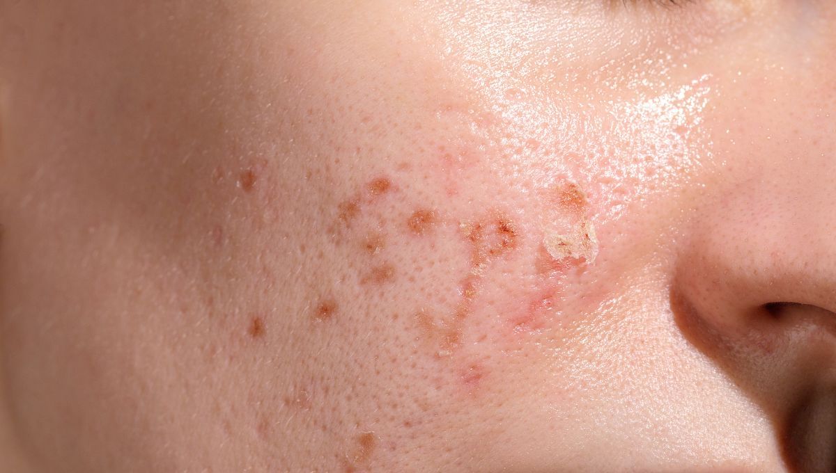 Durante el verano hay que aplicar en la piel productos que ayuden a regular y controlar la producción de sebo. Durante el verano hay que aplicar en la piel productos que ayuden a regular y controlar la producción de sebo. 