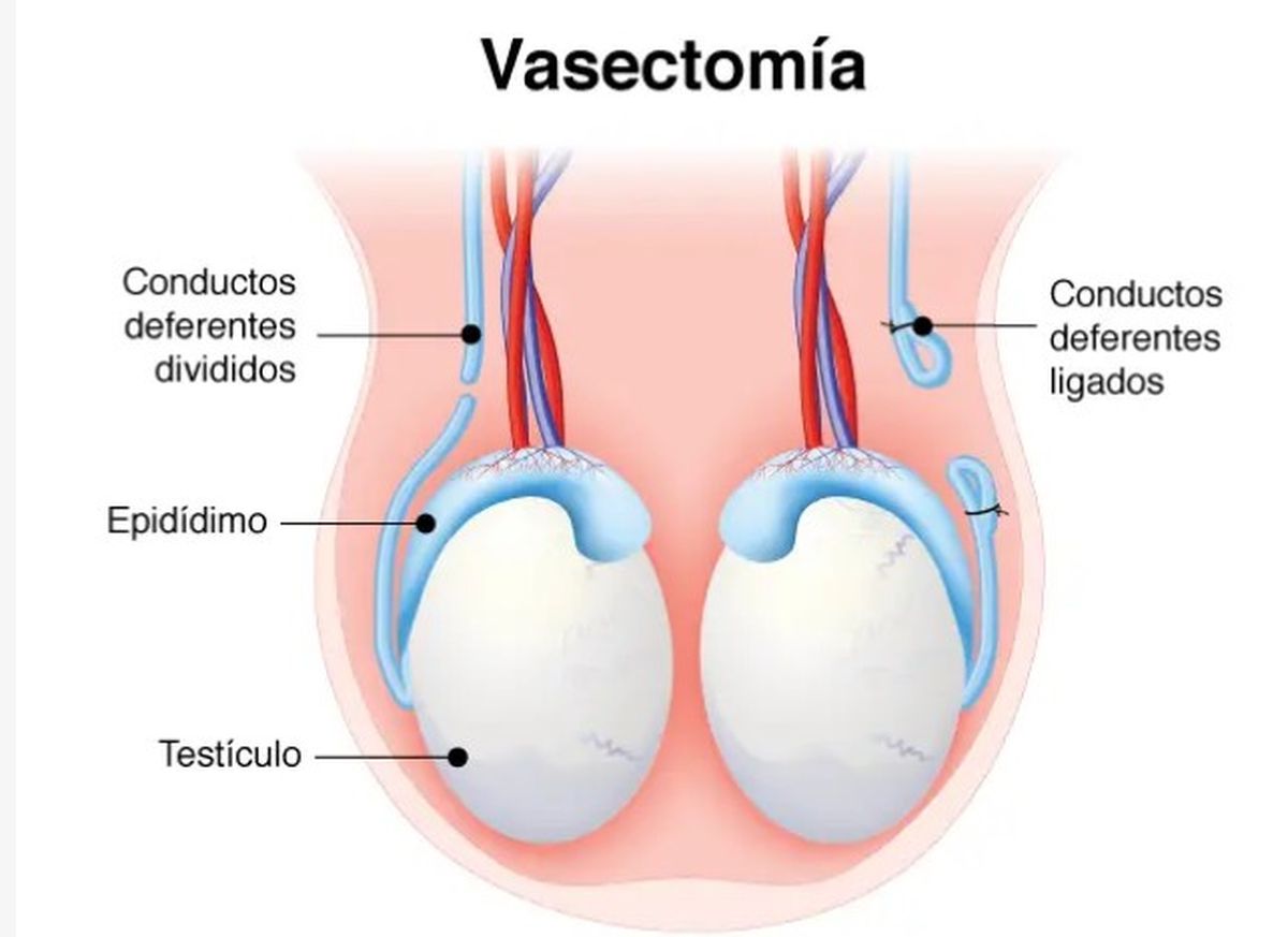 En este gráfico se puede ver en qué consiste una intervención de vasectomía. En este gráfico se puede ver en qué consiste una intervención de vasectomía.