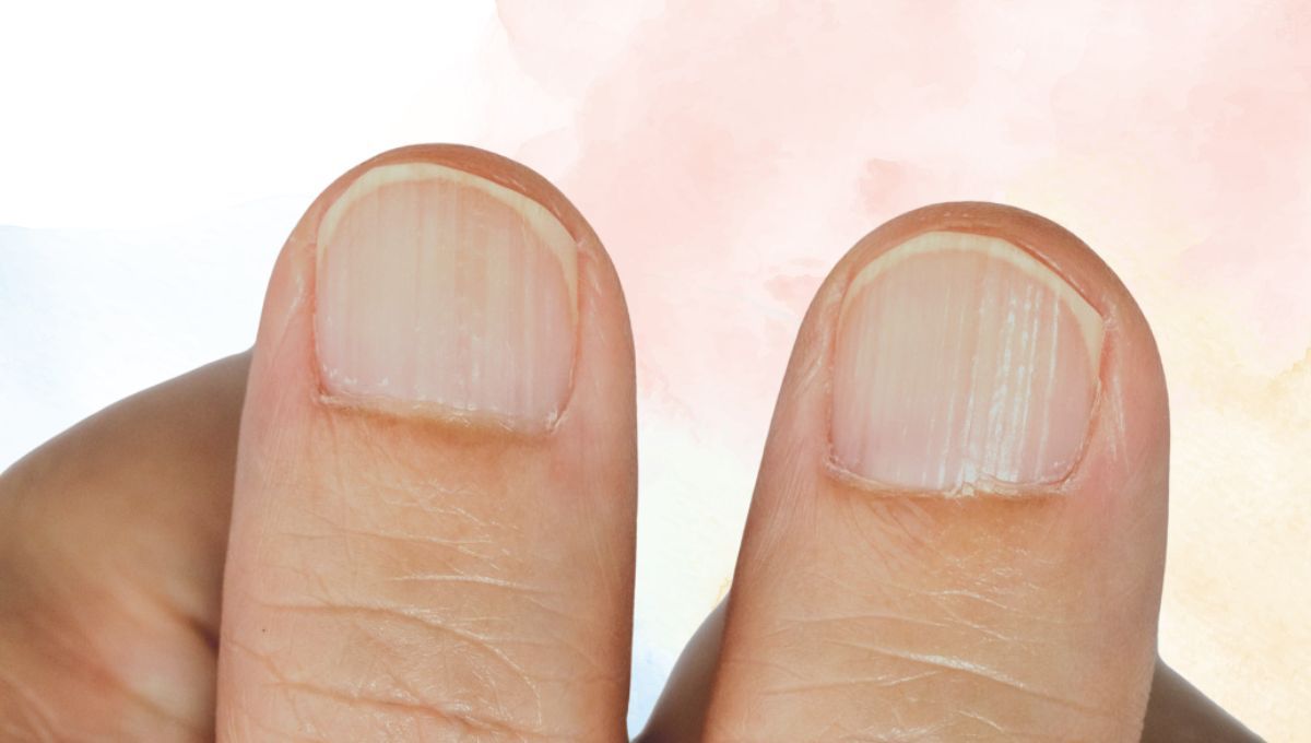Las rayas en las uñas pueden deberse a un problema genético. Las rayas en las uñas pueden deberse a un problema genético. 