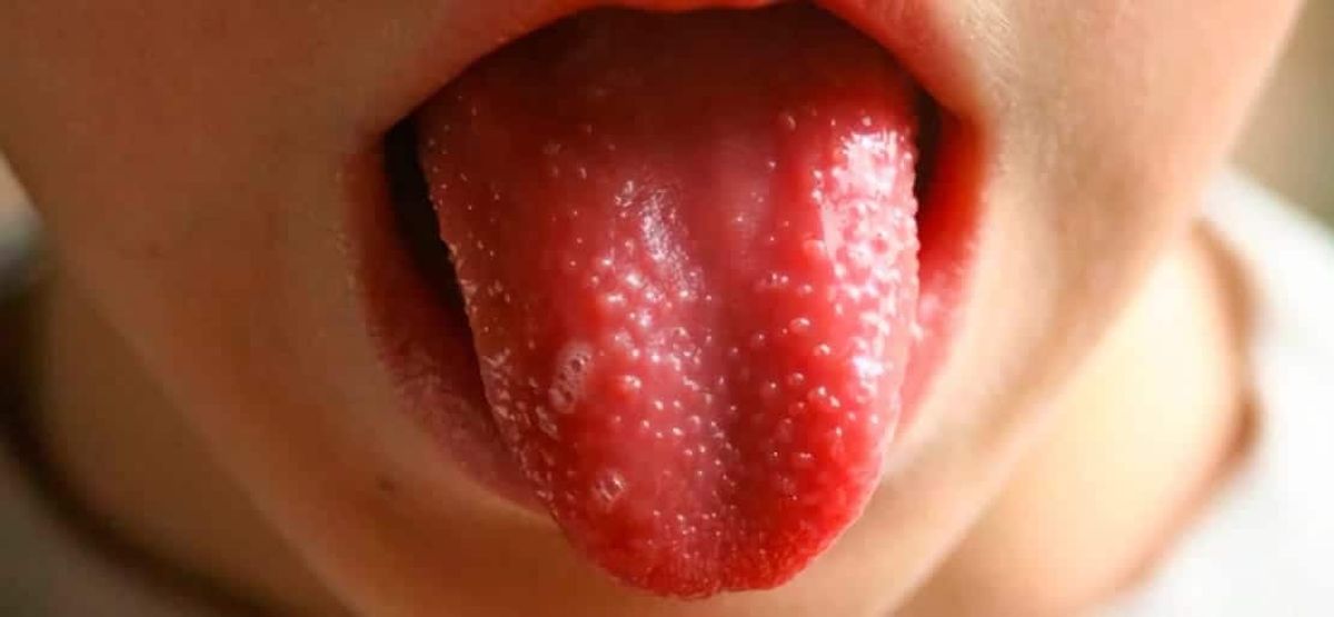 Lengua ardiente y con ampollas. Lengua ardiente y con ampollas.