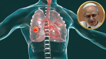 Qué es el adenocarcinoma que le hallaron al papa León XIV y qué dice el último parte médico