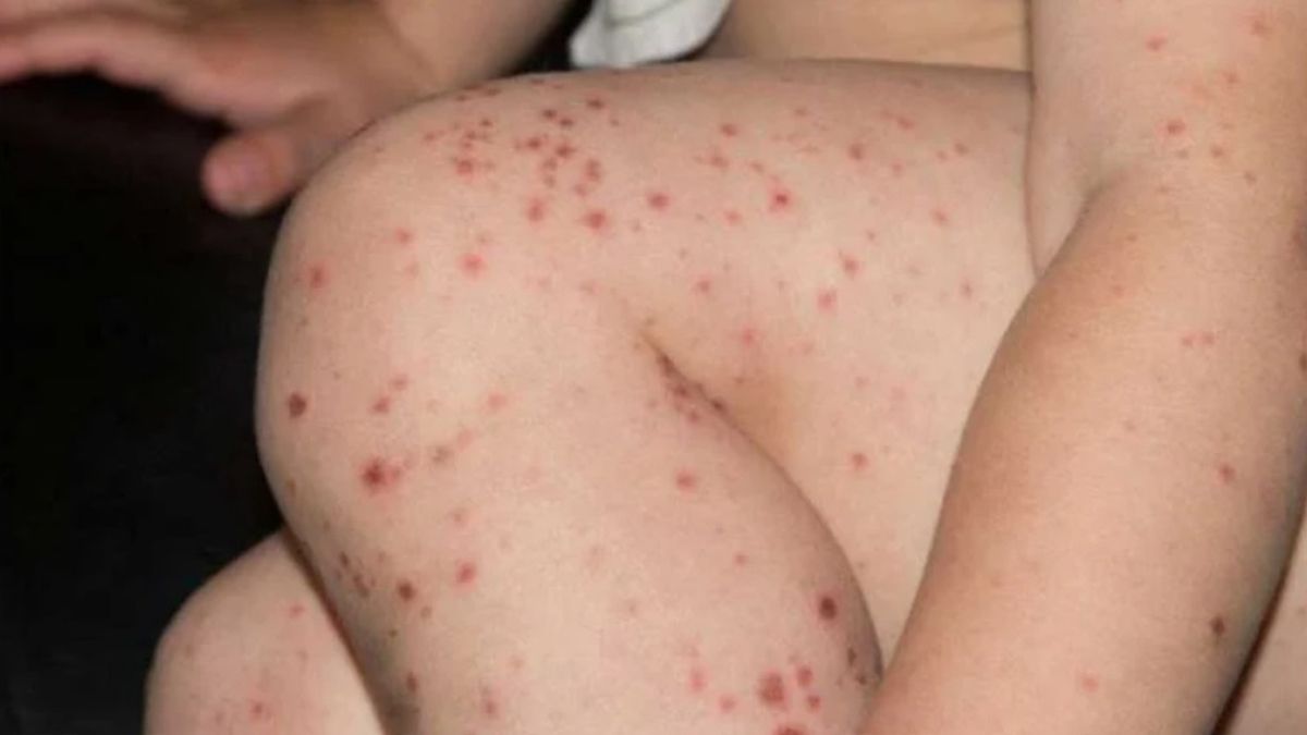 Ante la confirmación de un brote de sarampión en diez países de América, aconsejan reforzar la vacunación contra la enfermedad Ante la confirmación de un brote de sarampión en diez países de América, aconsejan reforzar la vacunación contra la enfermedad