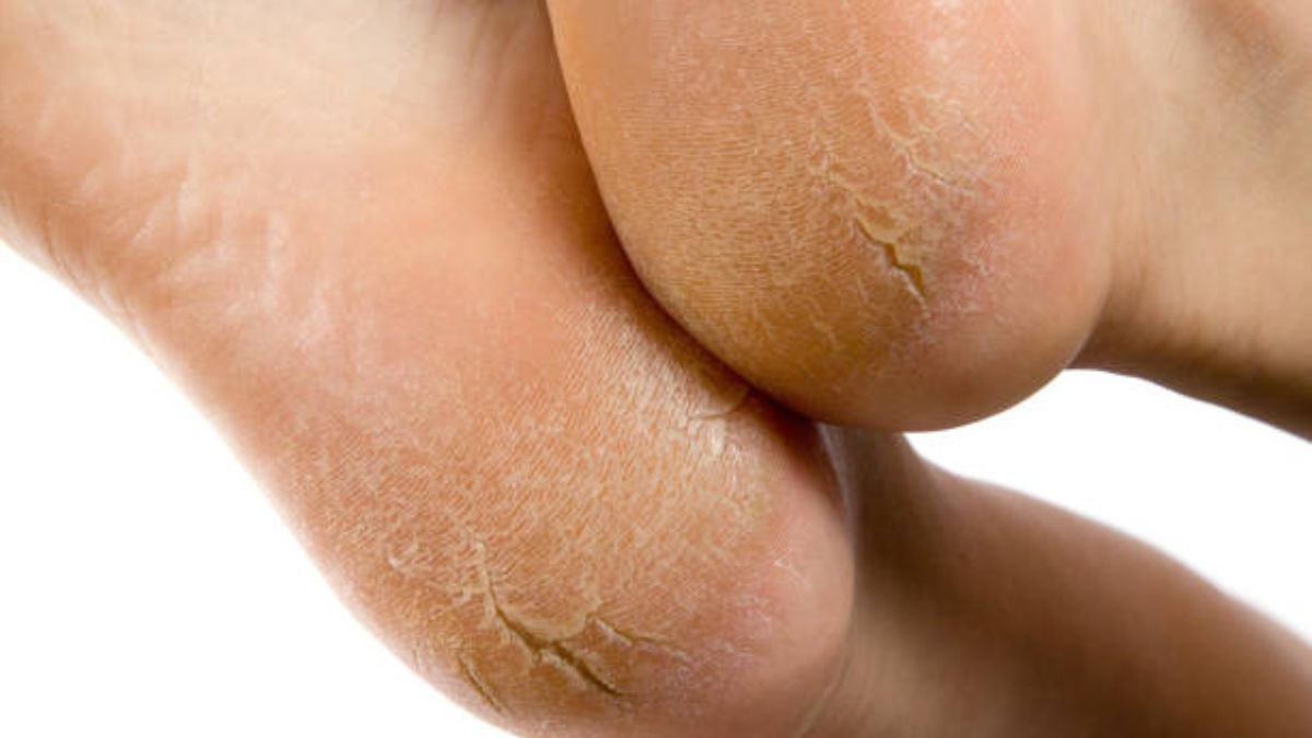 El remedio casero de 2 ingredientes ideal para reparar y humectar los talones agrietados
