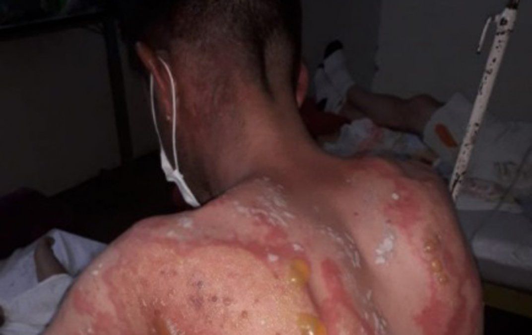 El joven quemado, de 32 años, es oriundo de La Paz. Se recupera en el hospital del Este.