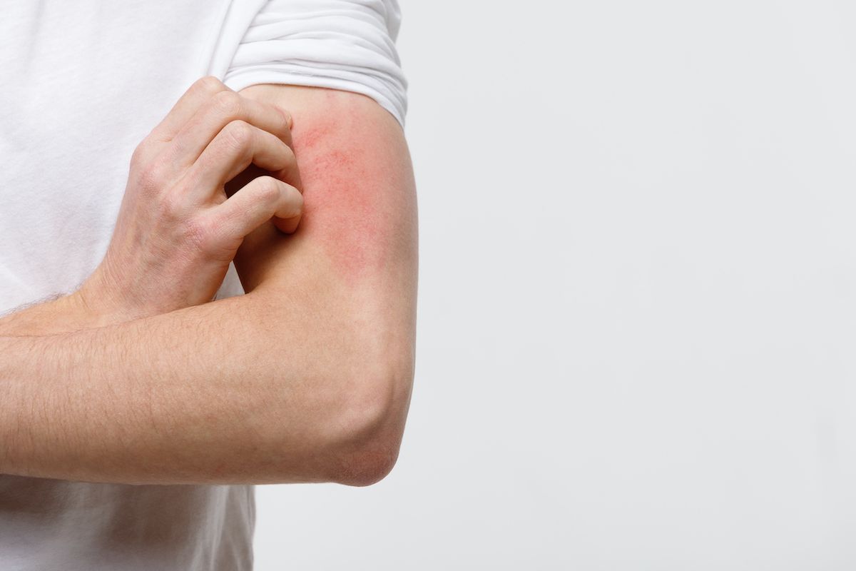 Dermatitis atópica. Dermatitis atópica. 
