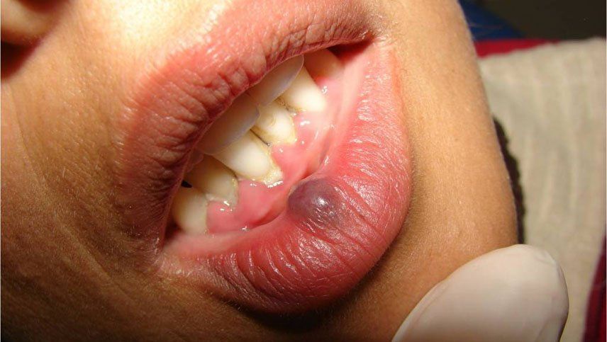 La UNCuyo se suma a la campaña Sacale la lengua al cáncer