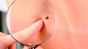 Identificá los lunares peligrosos con estos tips