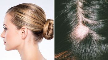 ¿Es verdad que los peinados tirantes con gel causan alopecia? ¿Es verdad que los peinados tirantes con gel causan alopecia?