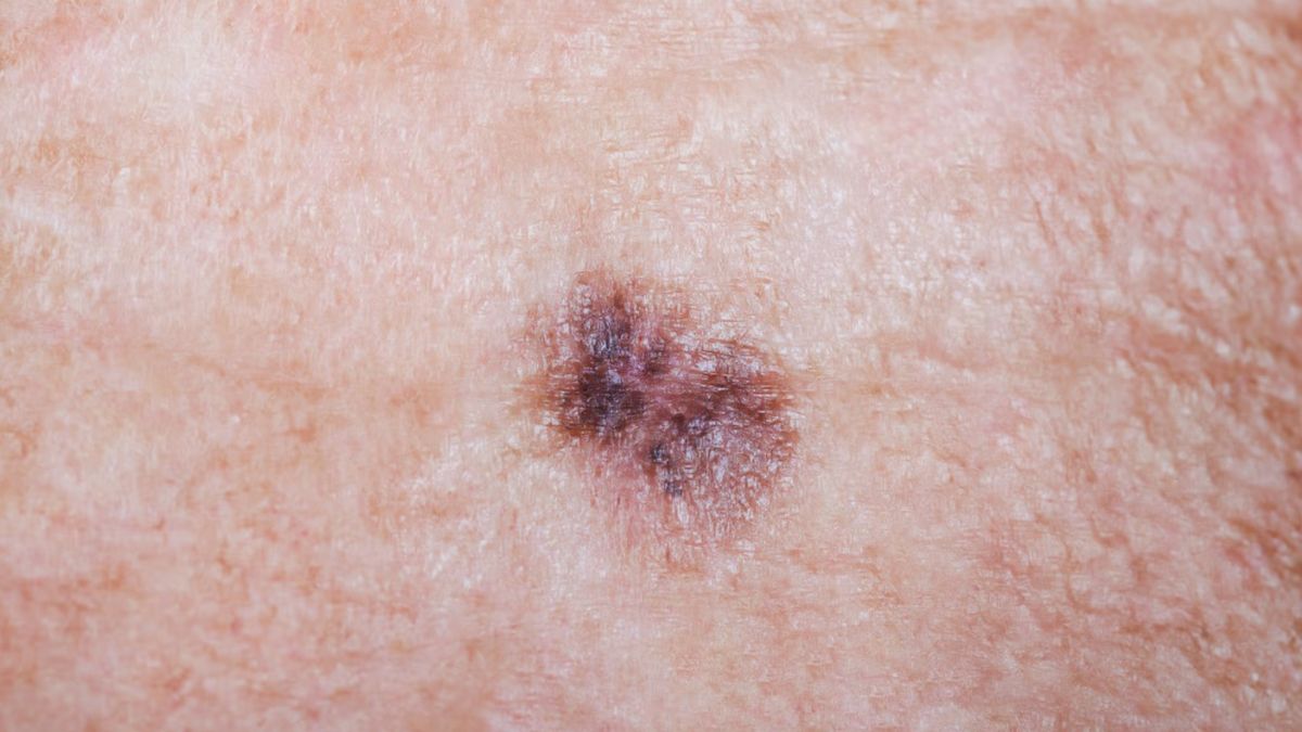 El cáncer de piel se produce por la formación de células malignas en los tejidos: cuál es el síntoma que puede salvar tu vida El cáncer de piel se produce por la formación de células malignas en los tejidos: cuál es el síntoma que puede salvar tu vida