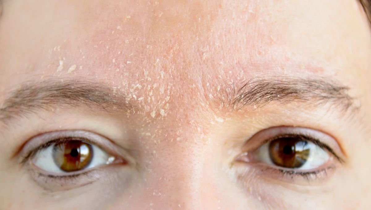 ¿Qué significa tener caspa en la cara y por qué aparece?