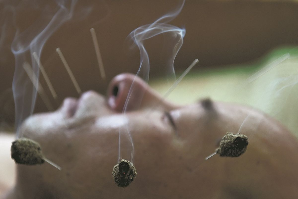 Tratamiento de moxibustión. ZHU JUN / PARA CHINA DAILY Tratamiento de moxibustión. ZHU JUN / PARA CHINA DAILY