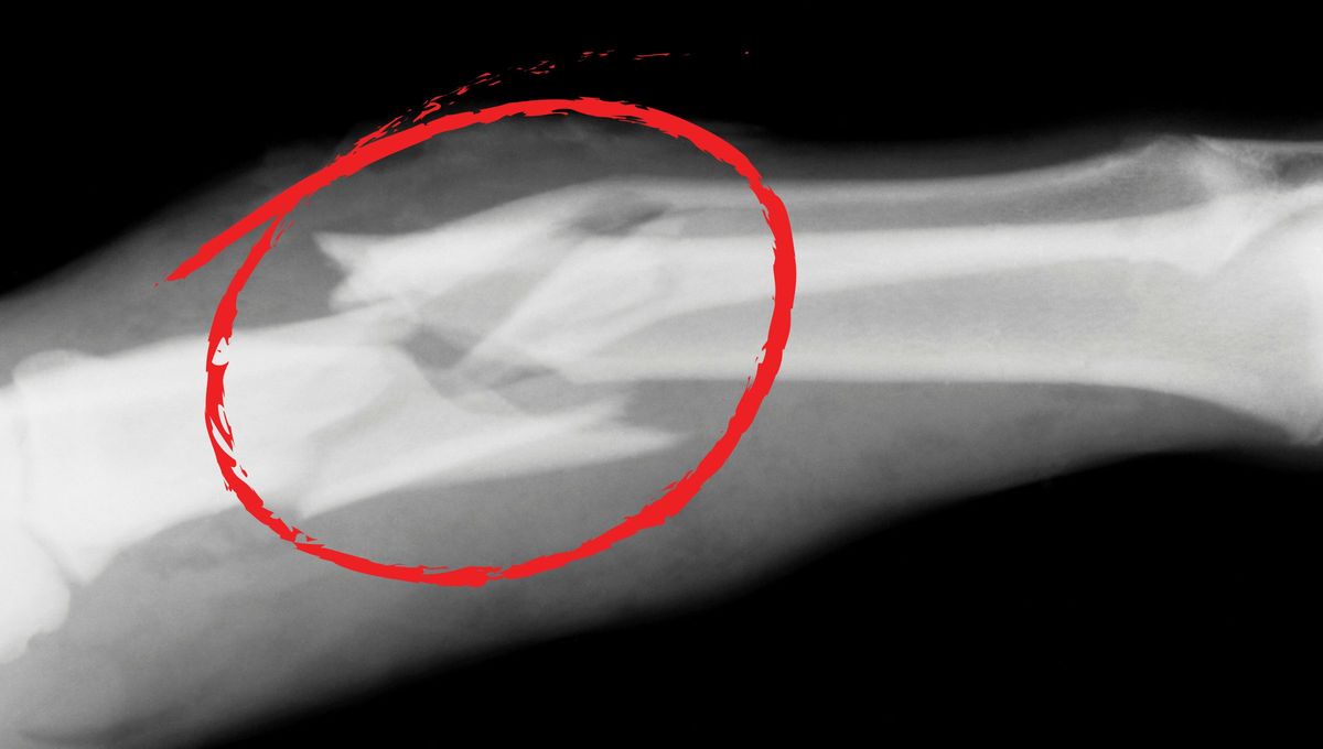 Ni caídas ni golpes: por qué algunas personas nunca se quiebran un hueso