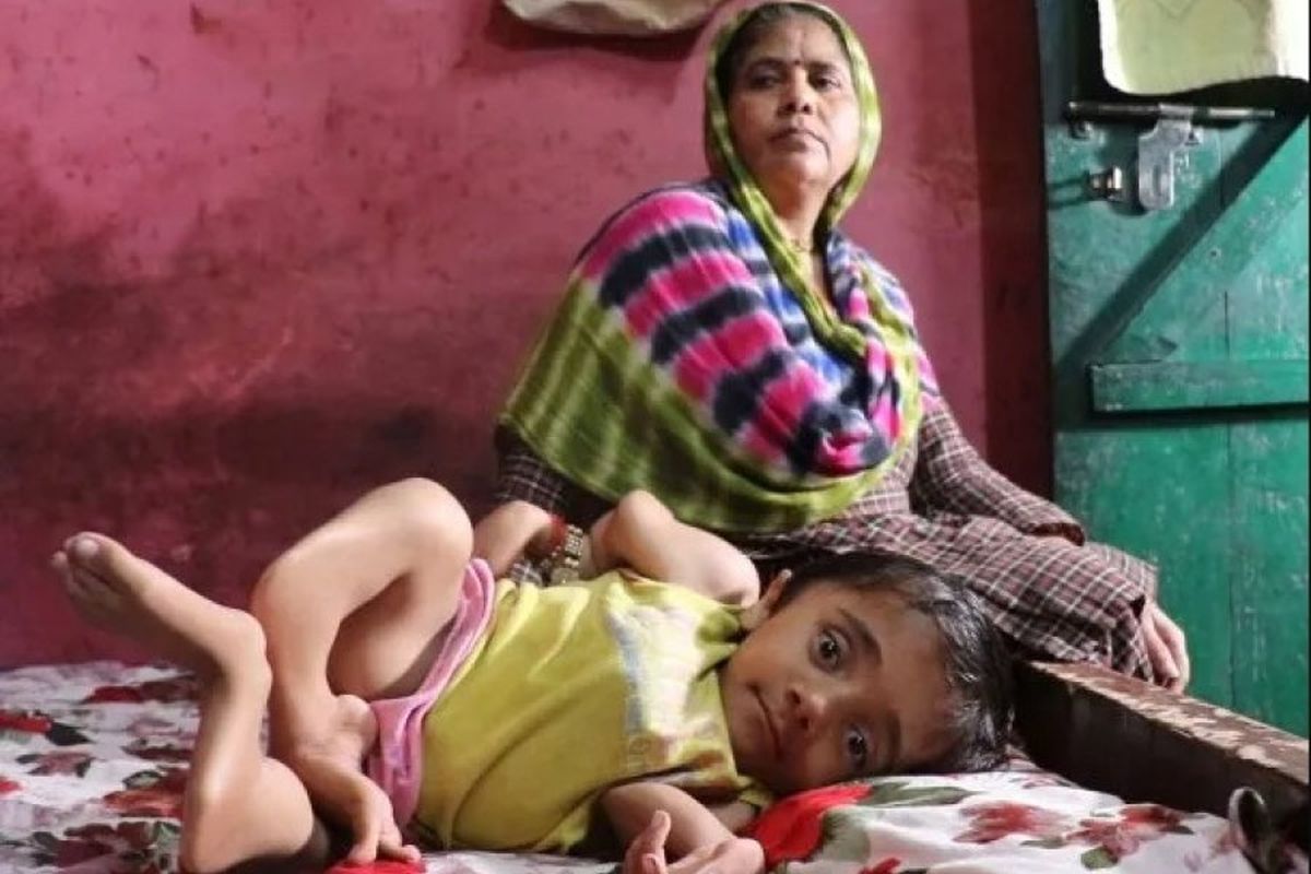 Dura enfermedad. La tremenda historia del "niño de vidrio": tiene 100 huesos rotos.