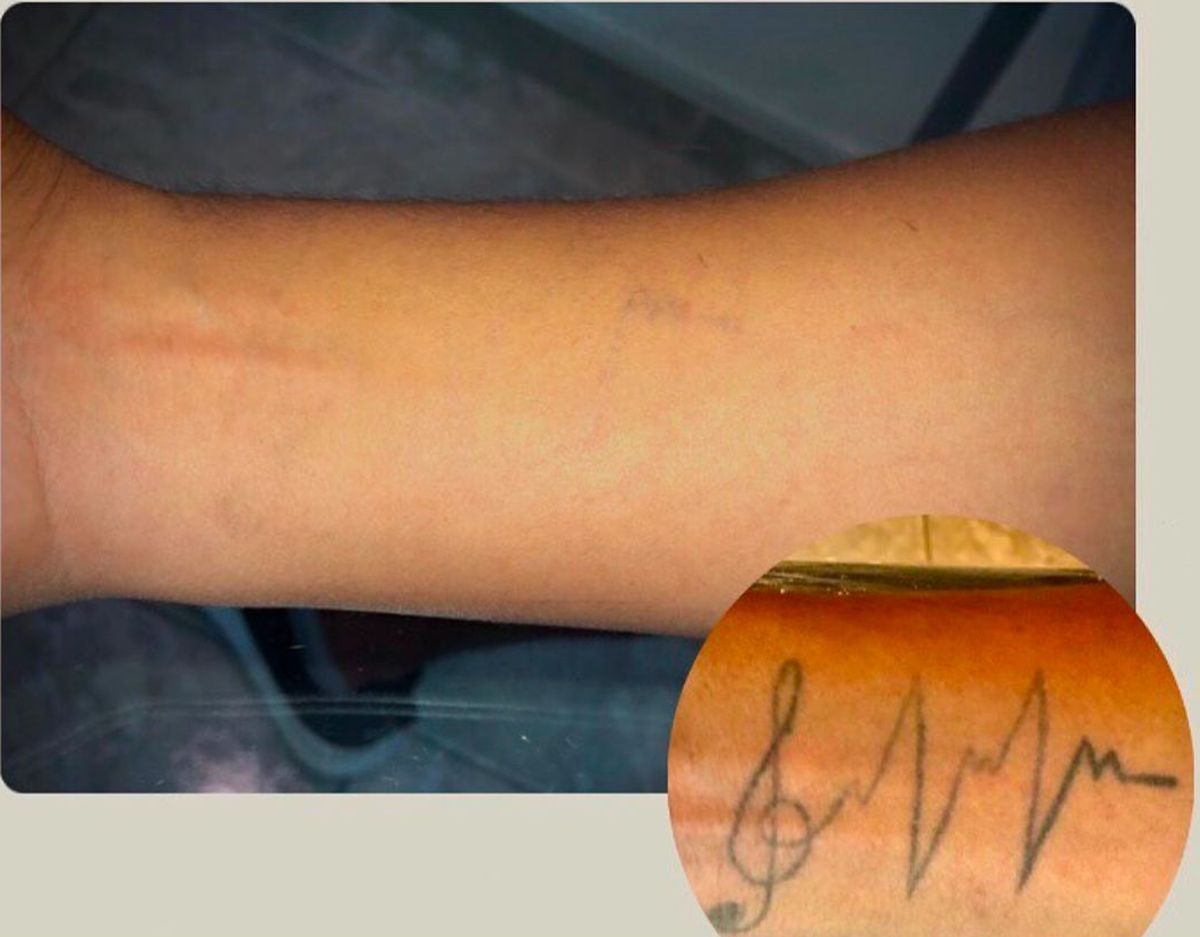 Tatuaje borrado con tecnología láser. Tatuaje borrado con tecnología láser.