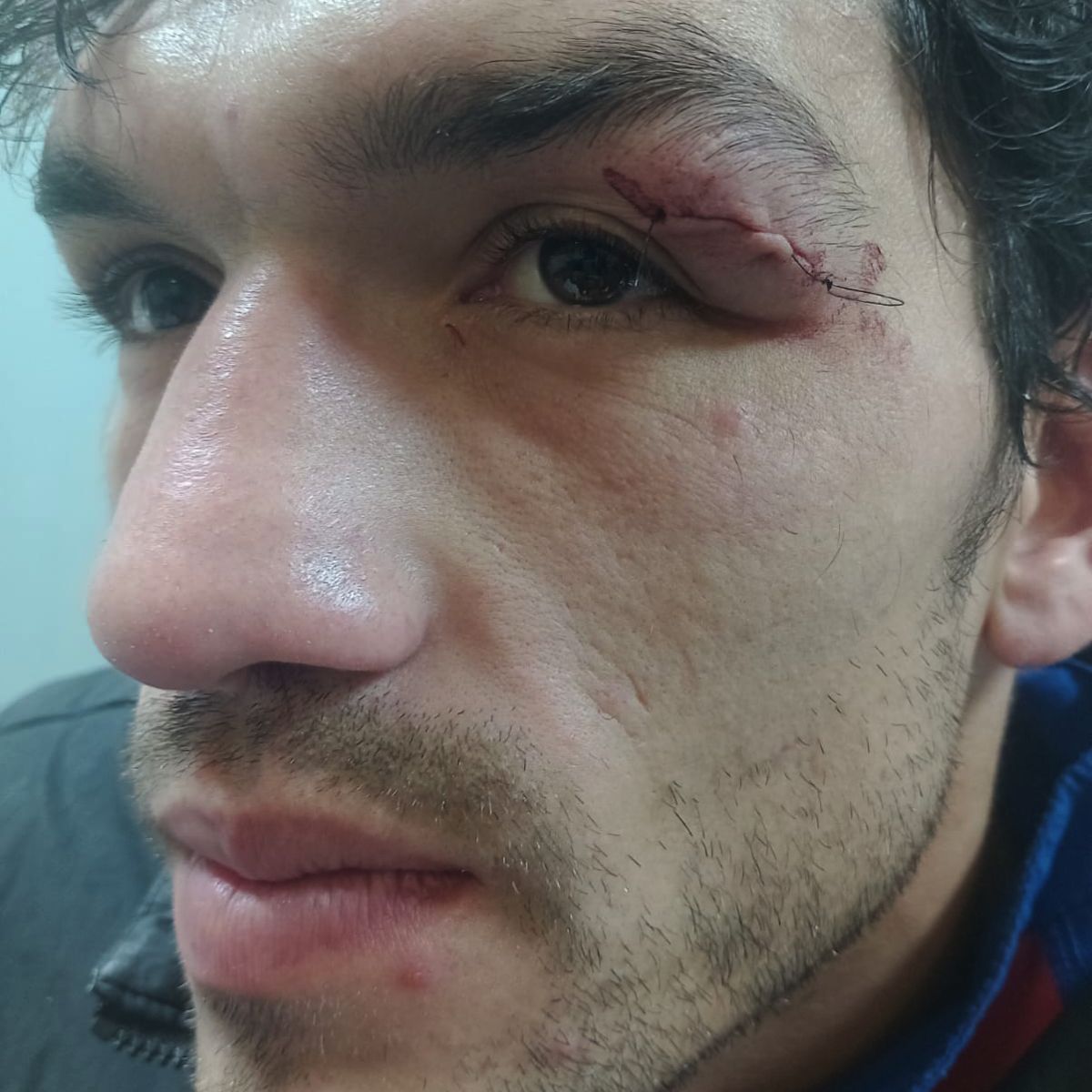 Así quedó la ceja izquierda de Juan Carrasco luego de la sutura en el Hospital Central. Así quedó la ceja izquierda de Juan Carrasco luego de la sutura en el Hospital Central.