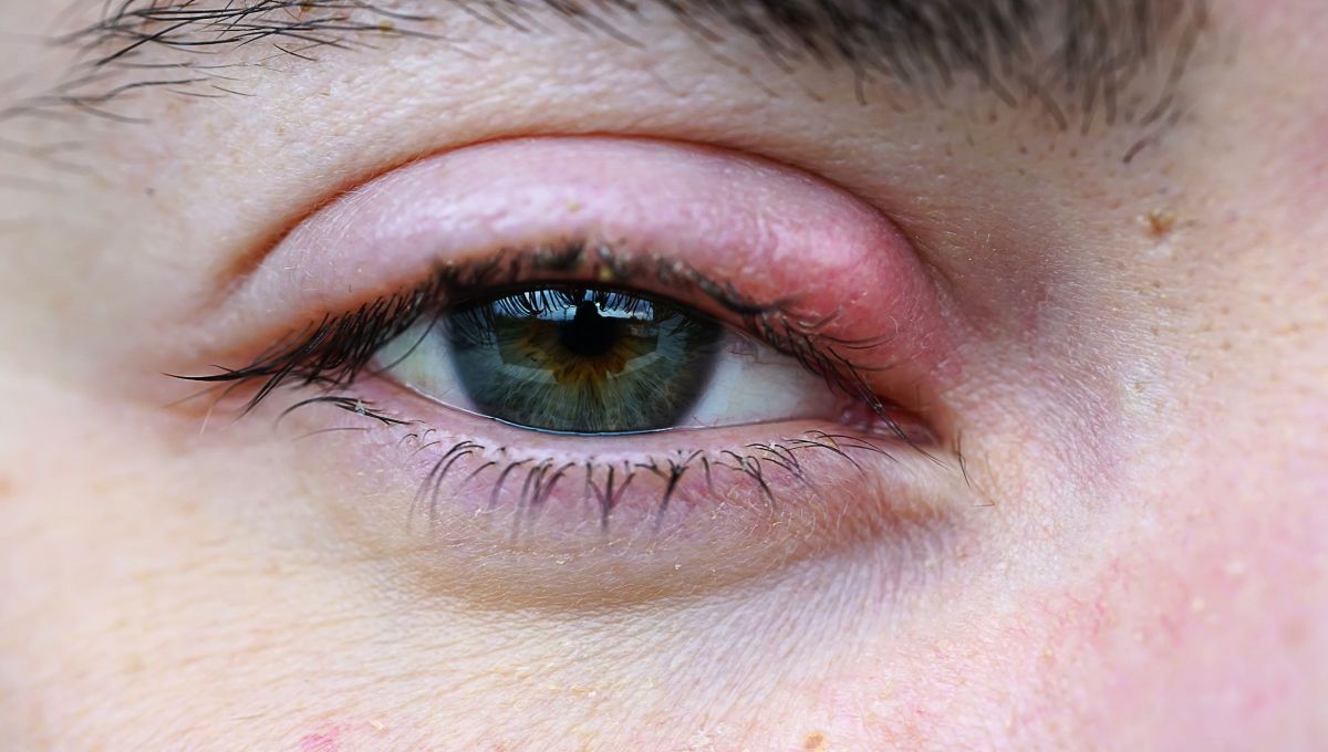 Qué significa que nos aparezca un orzuelo en el ojo y a qué se debe