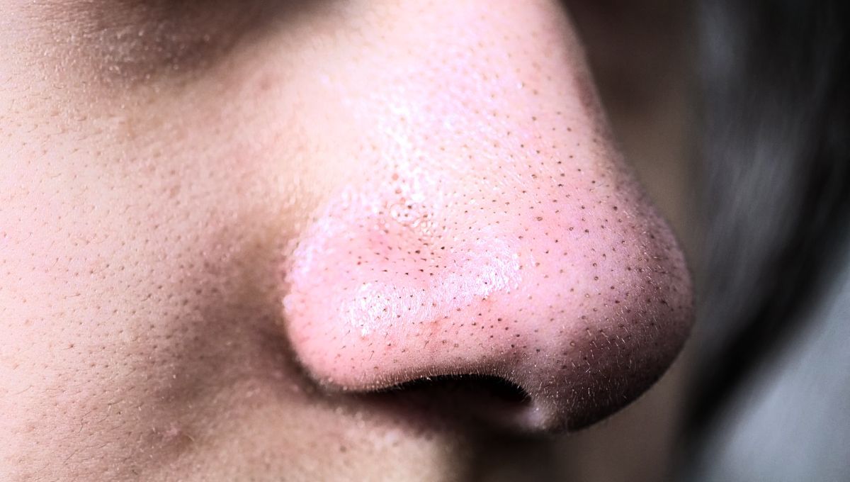 Los puntos negros en la cara pueden ser eliminados gracias a una efectiva mascarilla casera