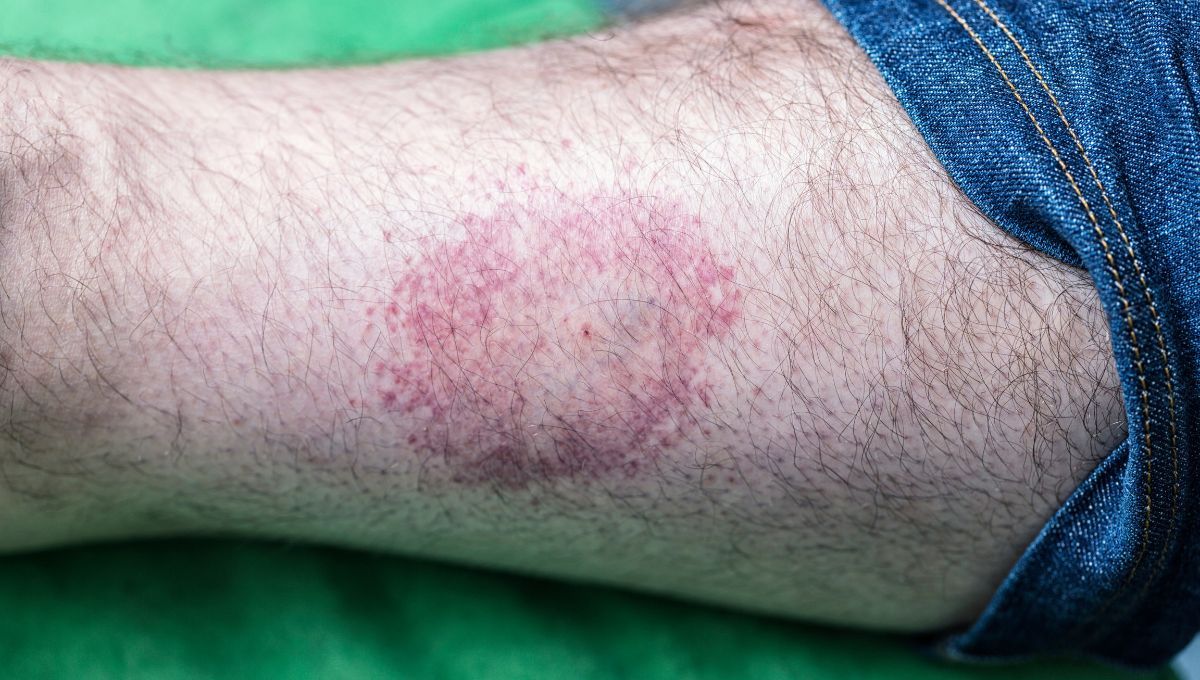 Picadura garrapata. Picadura garrapata.