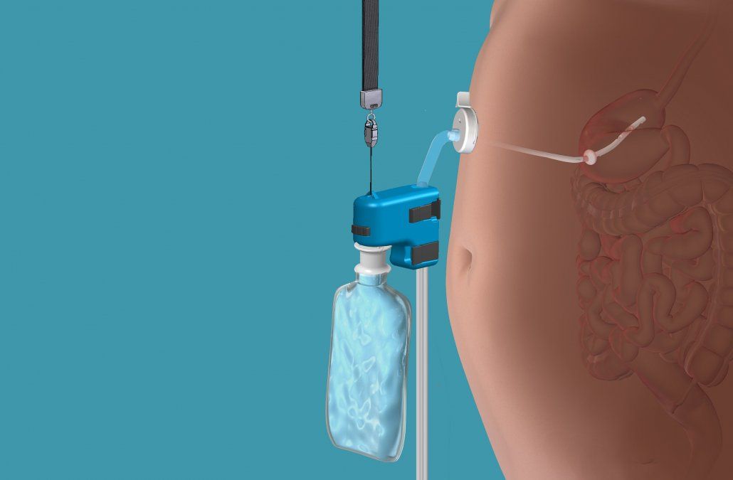 Aprobaron en Estados Unidos un nuevo dispositivo para tratamiento de obesidad