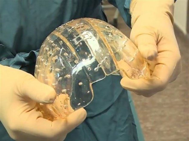 Por primera vez en el mundo, le implantaron a una paciente un cráneo de plástico impreso en 3D