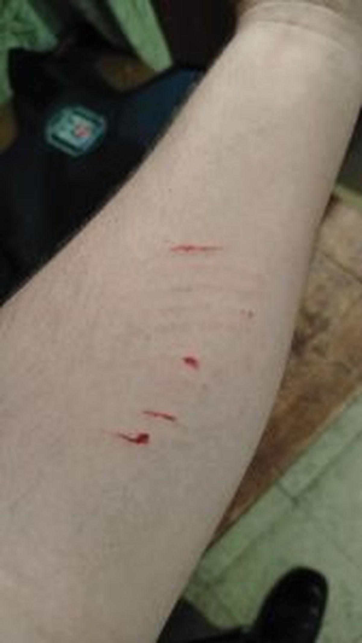 Heridas denunciadas por policías en la manifestación por la universidad pública en San Rafael. Heridas denunciadas por policías en la manifestación por la universidad pública en San Rafael.