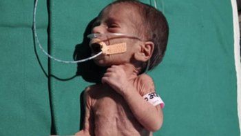 Así está hoy la bebita india prematura que enterraron viva en una cacerola
