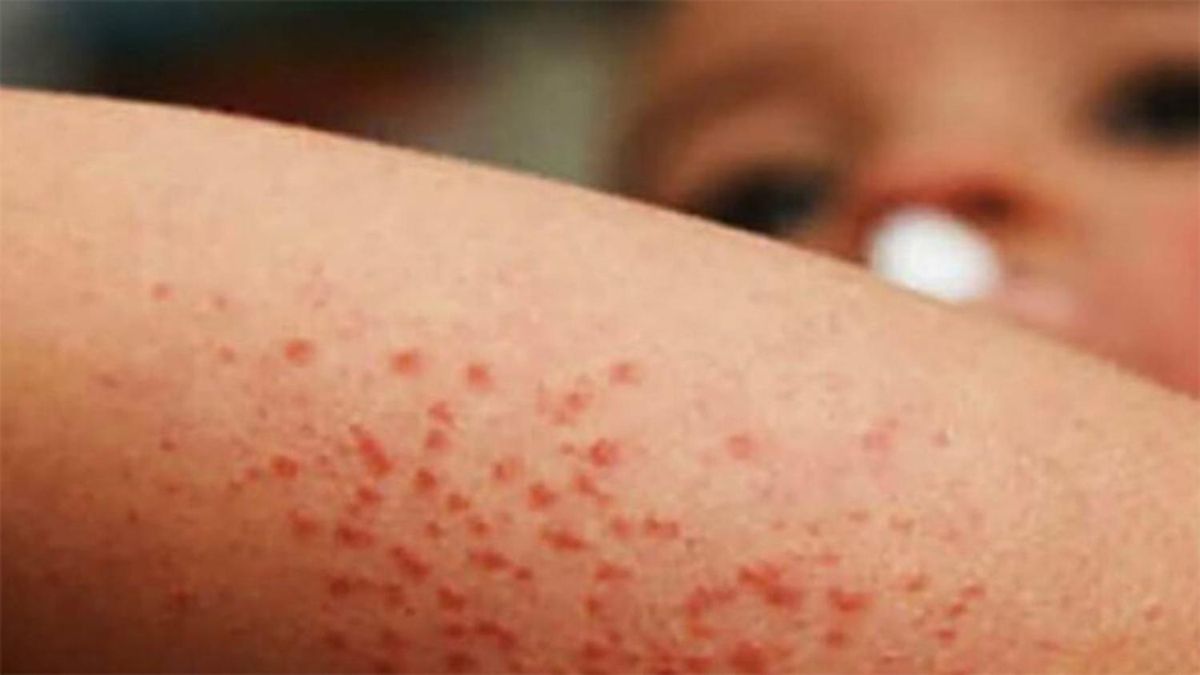 El alerta por sarampión que lanzó el ministro de Salud: 