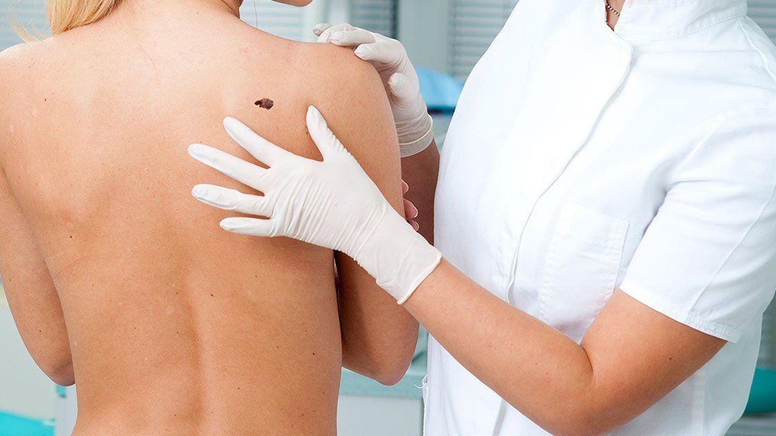 Lanzan una campaña de prevención del cáncer de piel