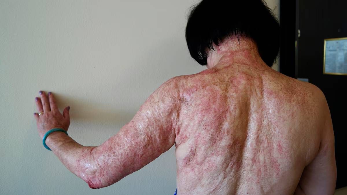 Kim Phuc sufrí quemaduras en el 65% de su cuerpo y hasta el día de hoy lleva esas marcas a pesar de los tratamientos que se ha realizado. Kim Phuc sufrí quemaduras en el 65% de su cuerpo y hasta el día de hoy lleva esas marcas a pesar de los tratamientos que se ha realizado.