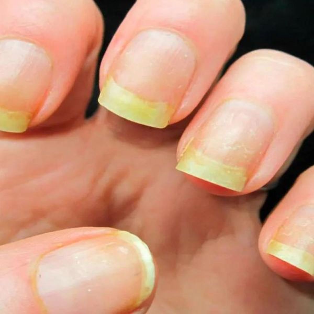 Uñas amarillas. Uñas amarillas.