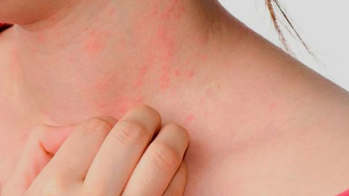 La urticaria provoca un impacto profundo en la calidad de vida y se estima que en Argentina entre el 12 y el 22% de la problación la padece La urticaria provoca un impacto profundo en la calidad de vida y se estima que en Argentina entre el 12 y el 22% de la problación la padece