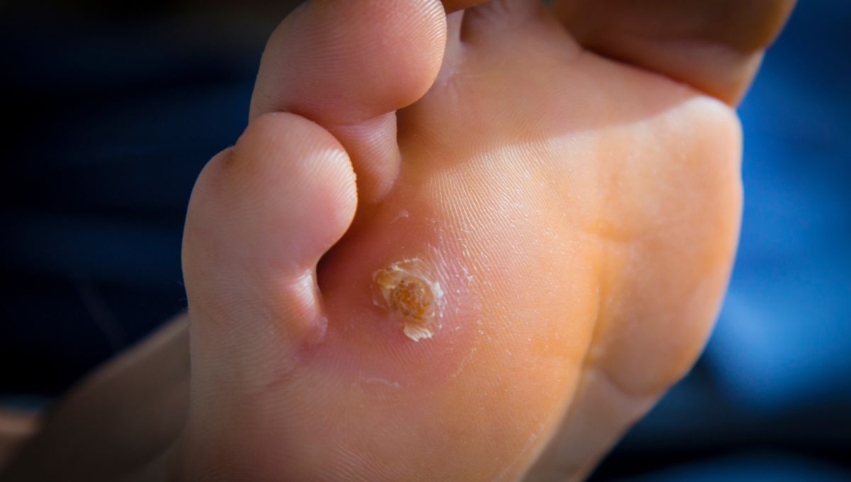 El vinagre es un ingrediente de cocina que ayuda a eliminar las durezas en los pies. El vinagre es un ingrediente de cocina que ayuda a eliminar las durezas en los pies.