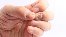 Aprende a cuidar tus uñas y previene los hongos de verano