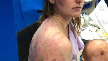 Así quedó una mujer tras proteger a su bebé del granizo