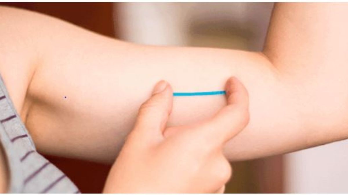 Cada vez más adolescentes utilizan el anticonceptivo subdérmico en Mendoza.Imagen ilustrativa.