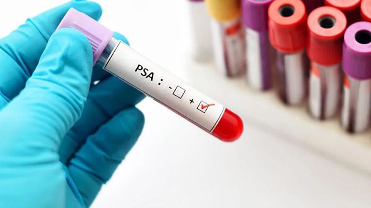 A través del PSA, antígeno prostático específico en análisis de sangre, se puede advertir si el paciente presenta cáncer de próstata A través del PSA, antígeno prostático específico en análisis de sangre, se puede advertir si el paciente presenta cáncer de próstata